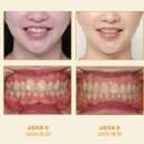 세움치과의원 | 김포 풍무동 교정치과 | 100프로 만족한 앞니 부분교정