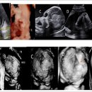 Prenatal diagnosis of single suture craniosynostosis 이미지