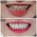 위드유치과기공소 | [위드유교정치과 평택]내돈내산/유지장치떨어져서 치과간김에 써보는 나의 교정후기/전후사진 있음
