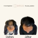 채우다SMP아카데미 | 더운 여름, 숱채움/SMP로 자존감을 채우다! [창원디플러스]