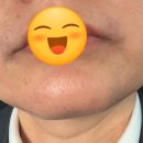남성수지 | 용인 수지구청역 피부과 젠틀맥스 프로 제모 남성 제모 턱수염 제모 후기