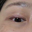 라인2차 | ♡아이라인 문신 타투 제거 2차 후기! 내돈내산♡