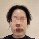 시청/명동입구 | 서울 시청역 피부과 방문기｜명동 30대 여자 티타늄 리프팅 추천 변화 후기