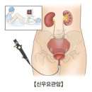 신우요관암 (Renal pelvis cancer) 이미지