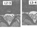 opera 님의 흉추디스크 T10-11, 요추디스크 L5-S1 의 MRI사진 판독입니다. 이미지