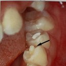 강종오 | 소아치과학, 유치와 영구치의 형태학적 차이점