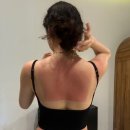 태양약국 | 발리 태양 무섭다…썬번 1도 화상 후기｜멘장안 스노클링 후 등 화상 + 가디언 알로에젤