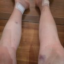 마이셀의원 | 마이셀 하지정맥류 수술 후기 (46세 / 가족력 有)