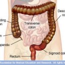 Ischemic colitis 이미지