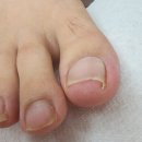 동성메디칼(주) | 금천내성발톱 제대로 도움받고 확실히 편해졌어요 포쉬네일 동성제약 풀리메디 금천점