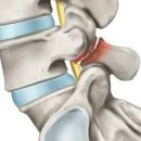척추분리증 , (척추 4번 5번) 이미지
