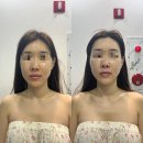 미인 | 청주윤곽관리 후광미인 후기 |얼굴 비대칭 라인 정리