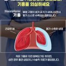 폐 기흉 증상 기침 가슴 통증 호흡곤란 기흉 원인 치료 이미지