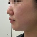 문정 피부과 추천 '온오프피부과' 에서 받은 온다리프팅 내돈내산 후기