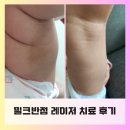 밀크피부과의원 | B-육아정보: 밀크반점이란? 아기 밀크반점 치료후기/ 대구애플피부과