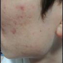 새살침 후기 볼 여드름흉터 압출부터 관리까지
