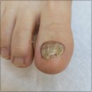 포쉬네일안산고잔점 | 안산발톱무좀 아프고 불편하다면 꼭 가보세요! 오벨리네일푸스 족보있는그녀들 안산점