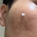 일랑일랑 | 여드름 얼굴 흉터 고민 낫츠 센텔라스카 연고 일랑일랑 후기