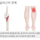 무릎 오금 통증 뒤쪽 통증이 느껴질 때 원인은 무엇일까요 이미지