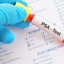 전립선의 검사란…PSA수치는 어떻게 판단하면 좋은가？ 이미지