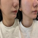 이촌약국 | 이촌피부과 리니어지받고 얼굴라인 리프팅 된 후기