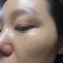 한국한센복지협회충북.세종지부부설충북의원 | 편평사마귀 제거 고민