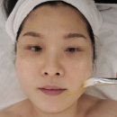 바른선 테라피 | 원주피부관리실 바른미에스테틱 : 울트라플라즈마 거상테라피 후기