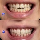 본치과의원 | 신사역 치아미백 고민하다가 레브치과 만족한 후기