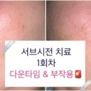 시전 | 서울 강남 피부과 여드름흉터치료 서브시전 2주차 경과후기 다운타임 멍 붓기 회복과정 솔직 후기