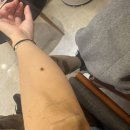 내맘에한의원 | 신부관리 몸에 난 큰 사마귀제거 분당쥐젖제거 분당편평사마귀무제한 한의원 내돈내산 후기