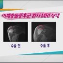 TV조선,생방송 선정형외과 선승덕대표원장 어깨충돌증후군 치료(3부) 이미지