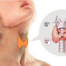 제일보청기 이미지