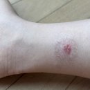 더나은한의원 | 주사피부염(+ 다리 습진) 생기 한의원 내돈내산 후기