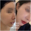 (주)제네시스서비스분당 | 신사피부과 제네시스 네오빔레이저 엑소좀5cc 효과 내돈내산 후기