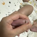 이뽀라성형외과의원 | 아기 발바닥 점, 아기 발바닥 모반,이뽀라성형외과에서 점빼기