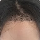 내방약국 | 대전 모발이식 비절개 내돈내산 1일차~14일차 후기(개구리알, 딱지, 머리 감는 방법 등)