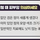 피부암 초기증상 발생 원인과 예방법에 대하여 이미지