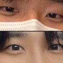 부산 남자 쌍수 눈매교정 재재수술 발품 찐 후기
