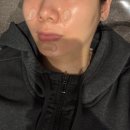 수분옆들 | 안양 피부과 수분관리 제네시스 레이저 + 물광주사 2cc 쥬베룩 2cc 내돈내산 후기