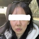 영앤이비인후과의원 | 신사역 뷰티앤영의원 뷰컷 후기
