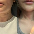선릉역 피부과에서 턱라인 정리 튠라이너와 팻제로주사 후기