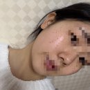 동아의원 | 주근깨 레이저 내돈내산 후기 반딧불의원