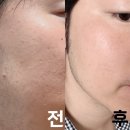 성지빌딩 | 편평사마귀 무제한 성지 HPV치료성지 강남역 병원 시술 후기+정보공유