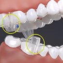 디오드림치과기공소 | 인비절라인 vs 투명교정 비용 기간 부작용 견색 모두 알려드림