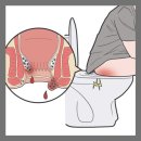 치핵수술 후기 회복기간 및 치질 좌욕 관리 올바른 노하우 공유