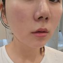 멍머리 | 화곡피부과 인모드후기💆🏻‍♀️ 인모드FX 멍 부작용 붓기 효과 땅콩형 볼패임