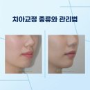 미소인치과의원 | 치아교정 종류 유지장치 맞춤 관리법, 고통 없이 평생 박제하는 법