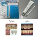 예소라트 | 🦷[내돈내산] 2주만에 미백 효과 본 화이트랩스 치아미백기 솔직 후기 | 치아 미백 종류 정리