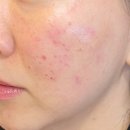 평생한의원 | 상계피부과 한의원 새살침 내돈내산 첫 내원 후기