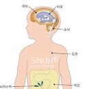 소아 성인 뇌수두증 증상 원인 션트 수술 치료 치매와 차이점 이미지